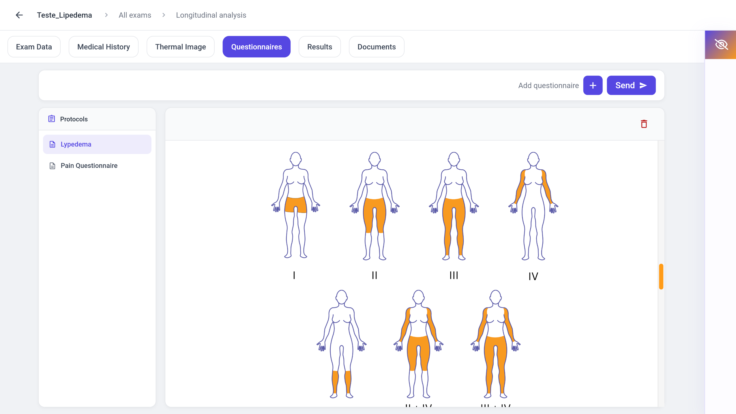 Lipedema questionnaire in the Vizbodx platform, showing body diagrams for stages I through IV and their combinations.
